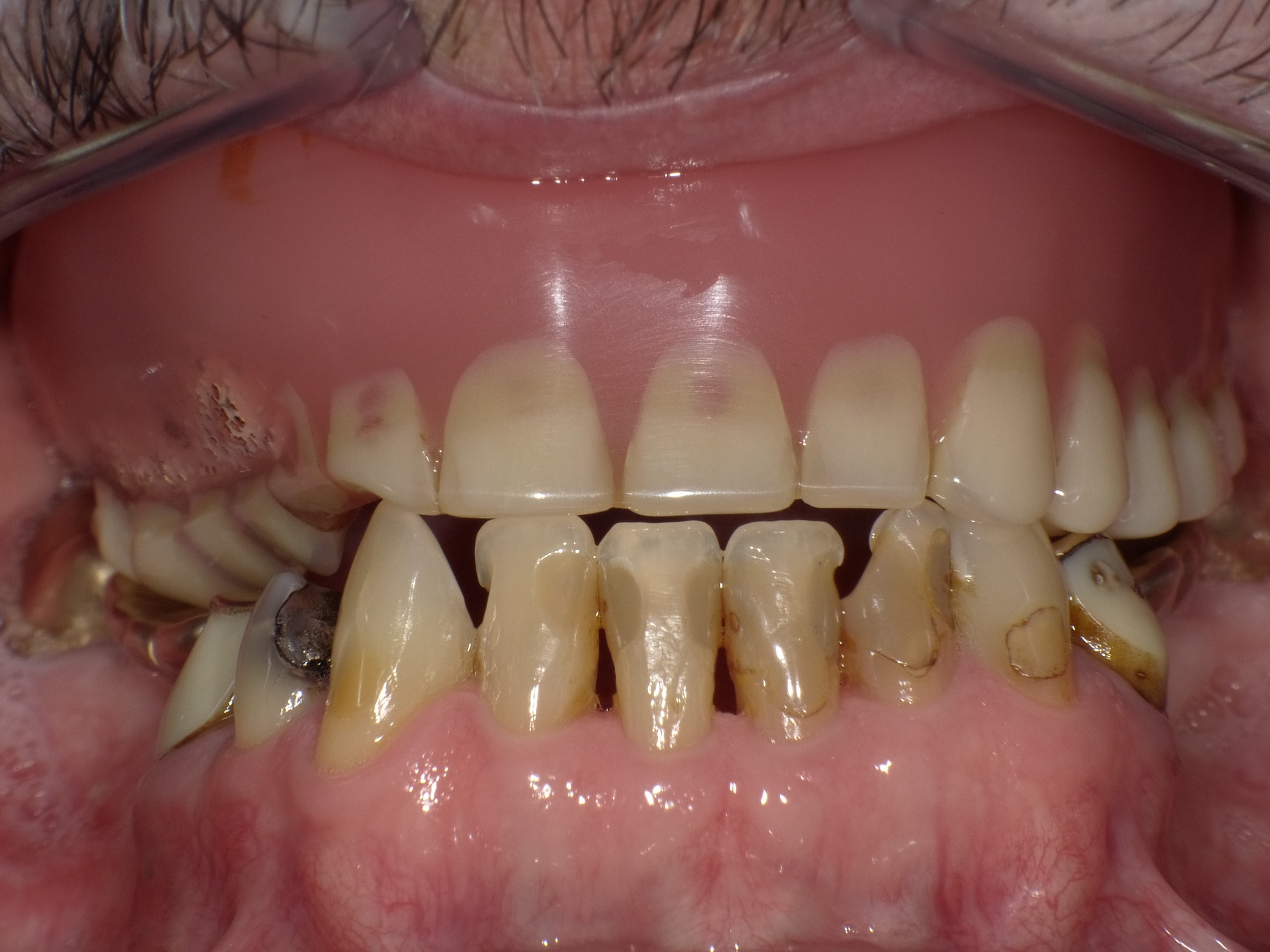 Angstpatient, der sich mittlerweile angewöhnt hatte, seine Zähne möglichst nicht zu zeigen und dadurch unfreundlich wirkte